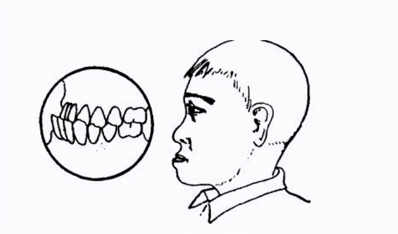 孩子龋齿要不要治疗,孩子龋齿要拔牙还是治疗