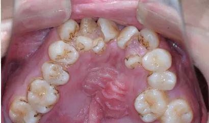 孩子牙齿不齐需要矫正吗,孩子牙齿不齐矫正有必要吗