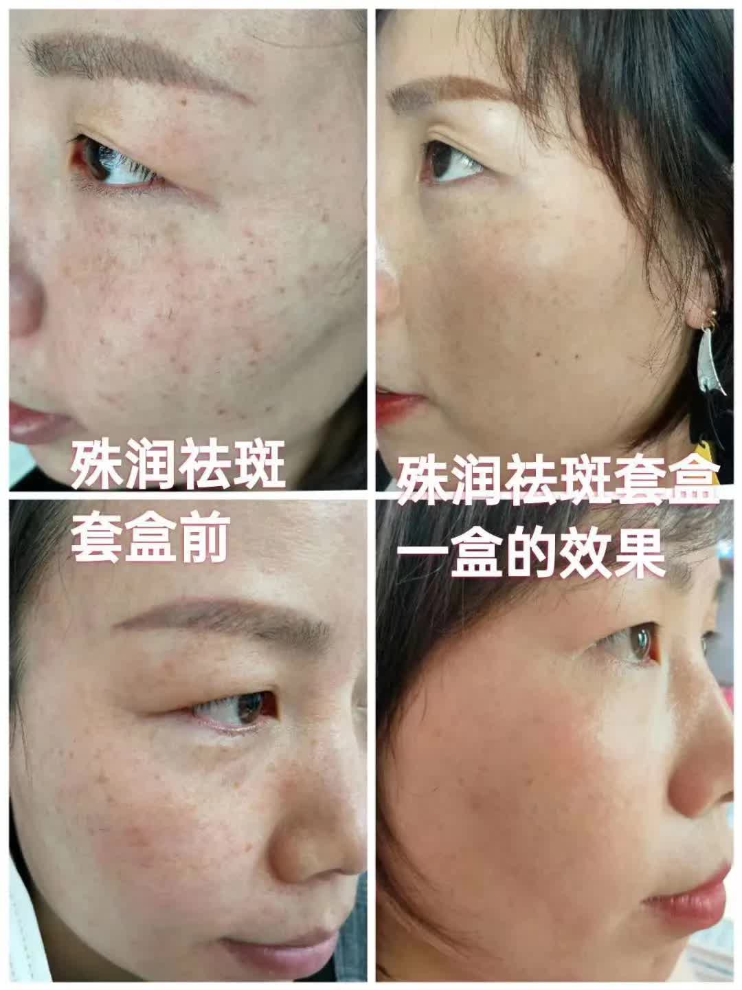 推荐好用的祛斑套盒,祛斑套盒推荐测评