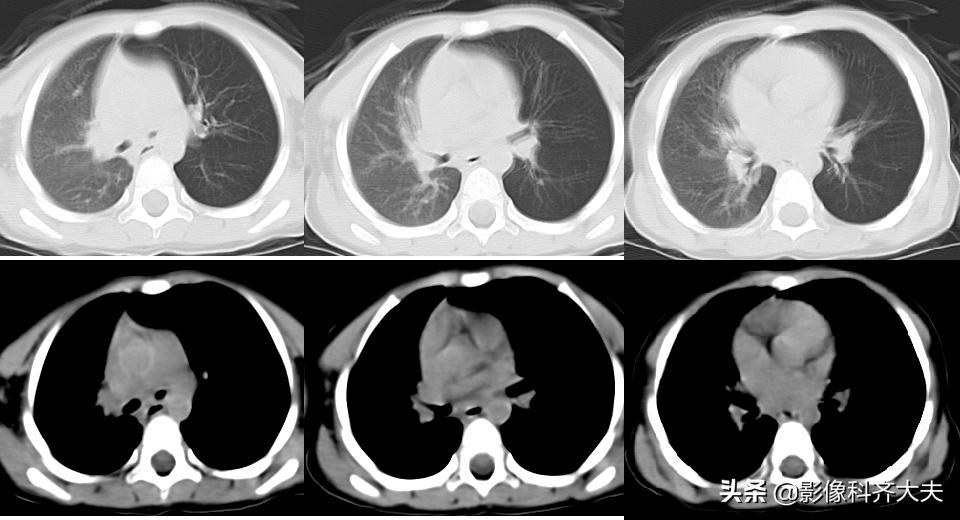 孩子支气管异物ct能查出吗,儿童支气管异物诊断方法