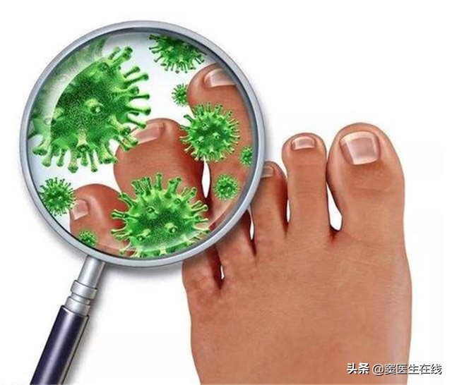 “脚气”真菌怎么治才能根除？2个简单小方法，彻底治好不复发