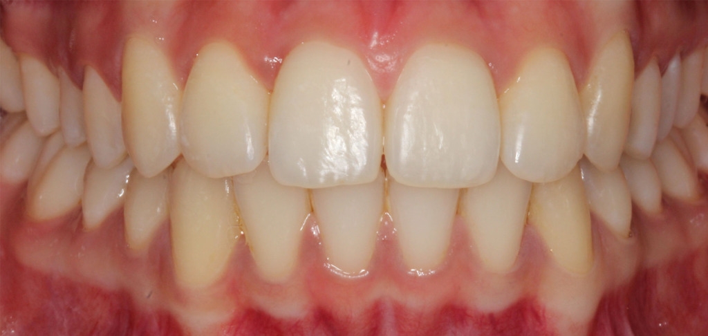 上门牙磕破了一小块怎么办,上门牙磕掉了怎样处理伤口