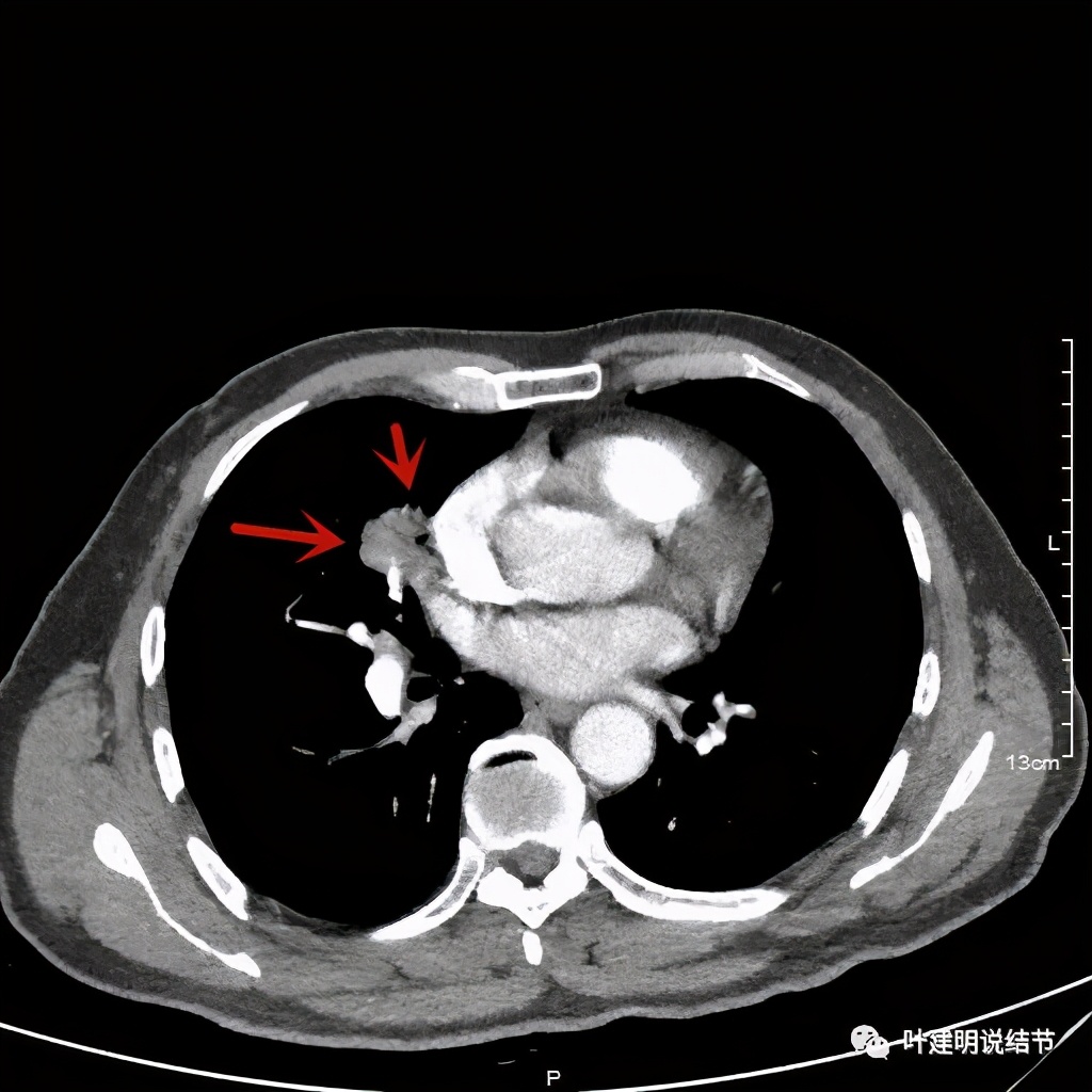 实性结节影要不要紧,实性结节穿刺活检为良性