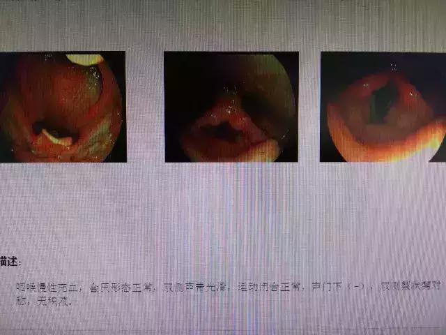 咽喉有异物感是喉癌吗,喉咙有异物感会是肿瘤吗