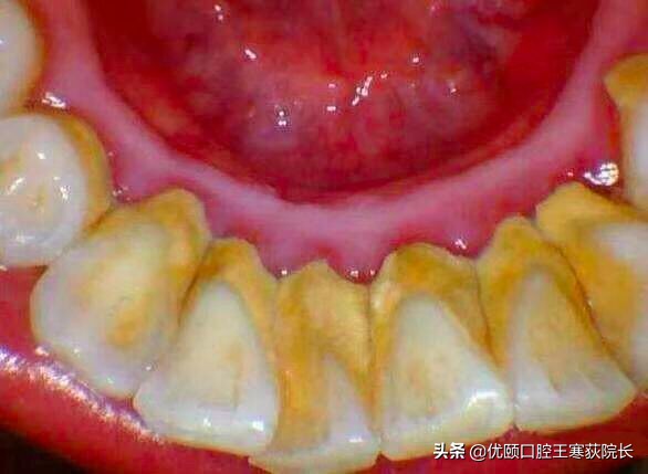 中国人为什么容易掉头发,中国人为什么牙齿龅