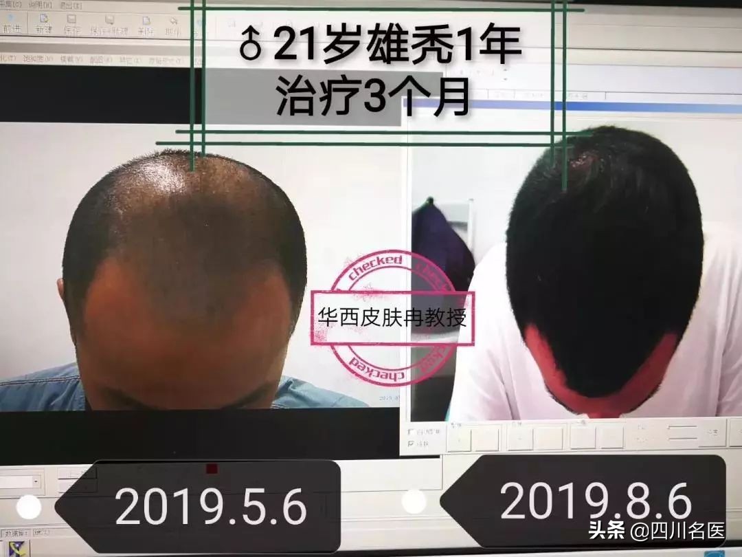 成都华西医院皮肤科雄性激素脱发,华西的皮肤科治疗脱发吗