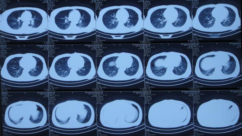 开颅手术后颅内细菌感染图片,外伤开颅手术后脑积液能恢复吗