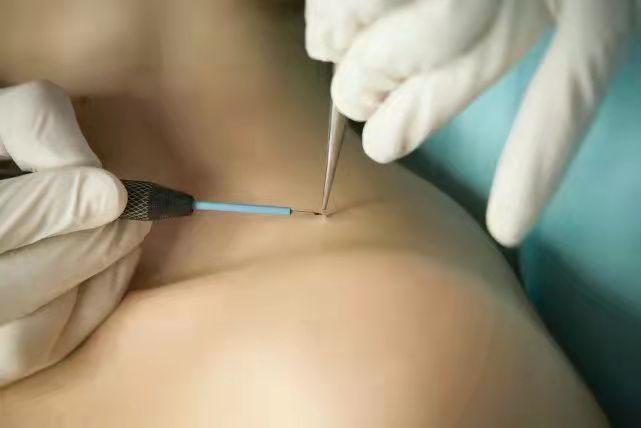 小揪揪是丝状疣吗,脖子上的小揪揪是什么