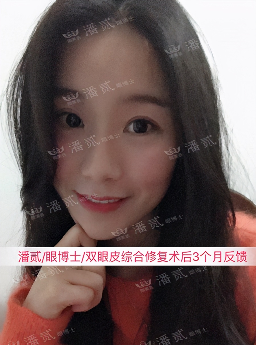 双眼皮整容失败眼皮跳动,双眼皮整形失败修复还花钱吗