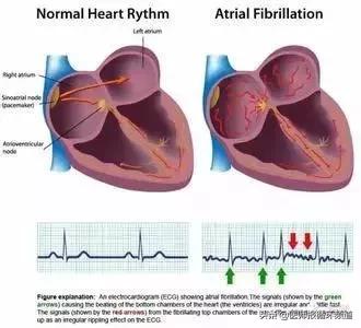 治疗房颤的安全高效方法,房颤窦性停搏安装起搏器指征