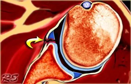 特殊骨折类型,特殊骨折体征
