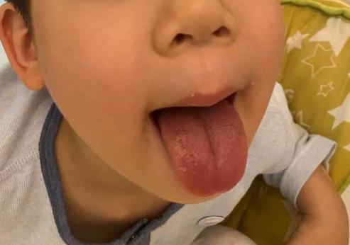 宝宝睡电热毯身上长疹子怎么办,孩子一出门就起疹子