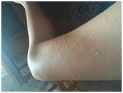 毛囊炎加鸡皮肤怎么根治,鸡皮肤和鱼鳞病怎样根治