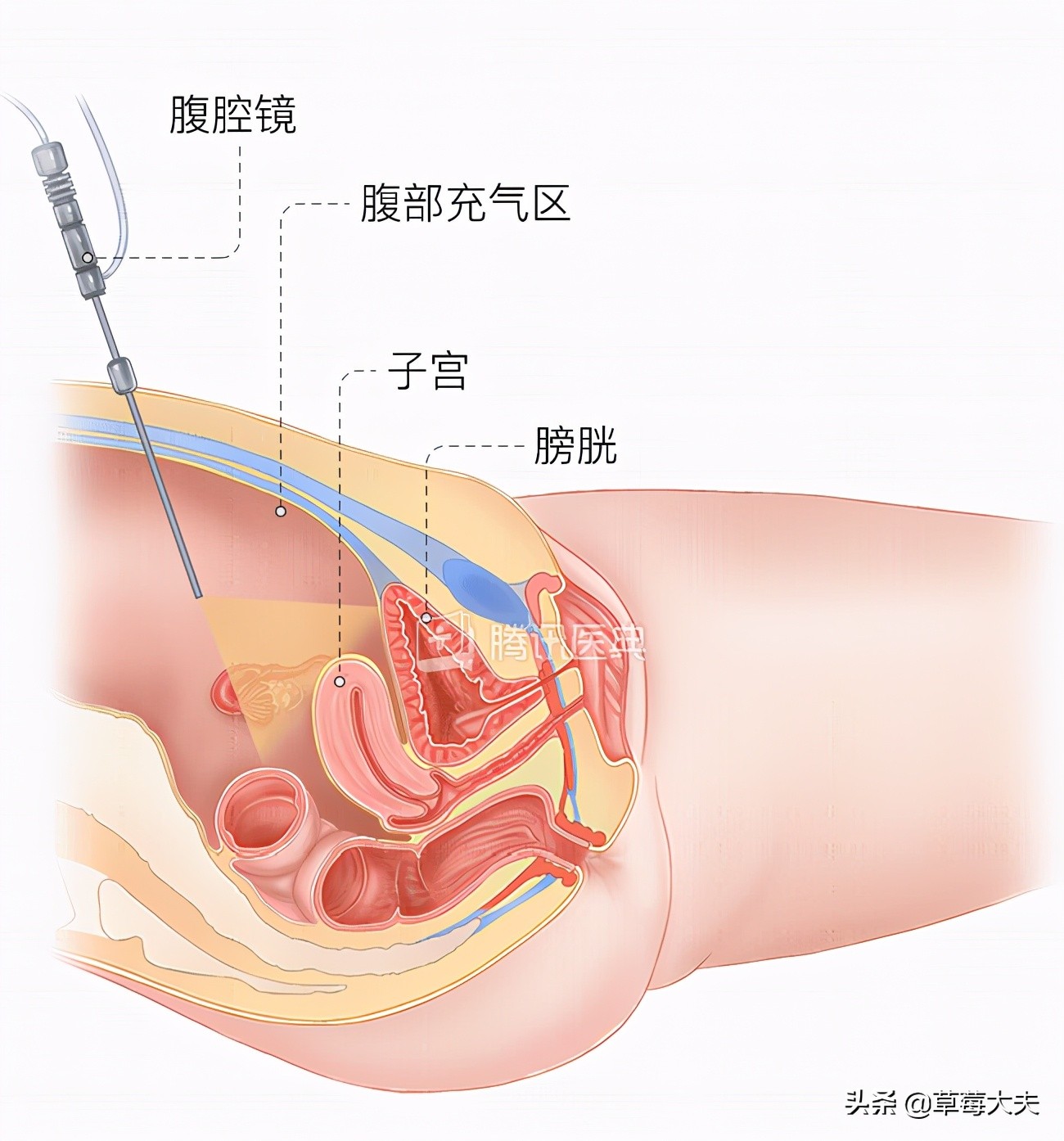 「人气案例」宫颈癌手术就得终生挂尿袋生活？草莓医院专家SayNo