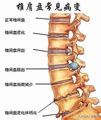 如何彻底解决腰突,你是否为了颈椎而烦恼
