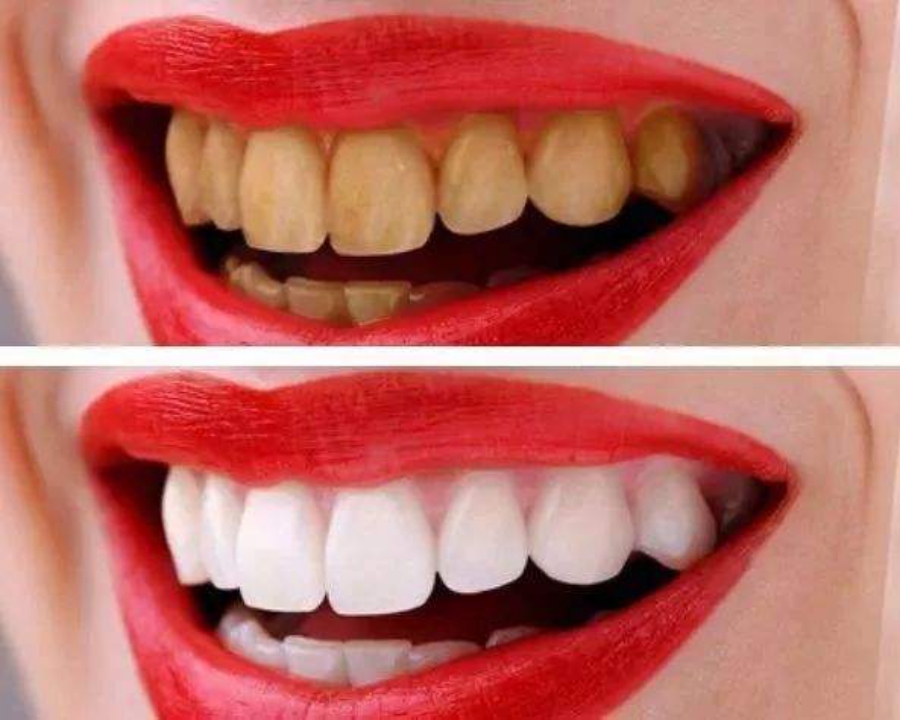 牙黄怎么刷也刷不白是怎么了,牙黄刷不掉怎么办用什么牙膏