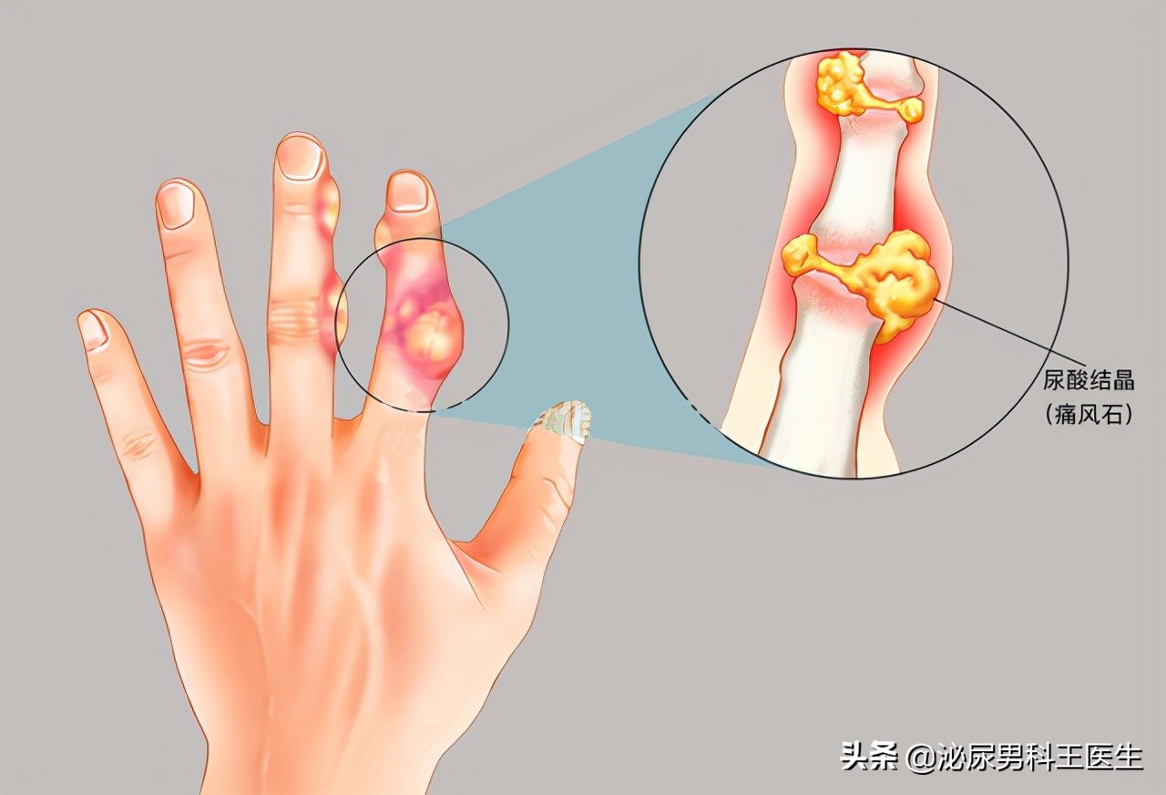 尿酸高肾脏受损的症状吃什么,尿酸高导致的肾功能损坏怎么办