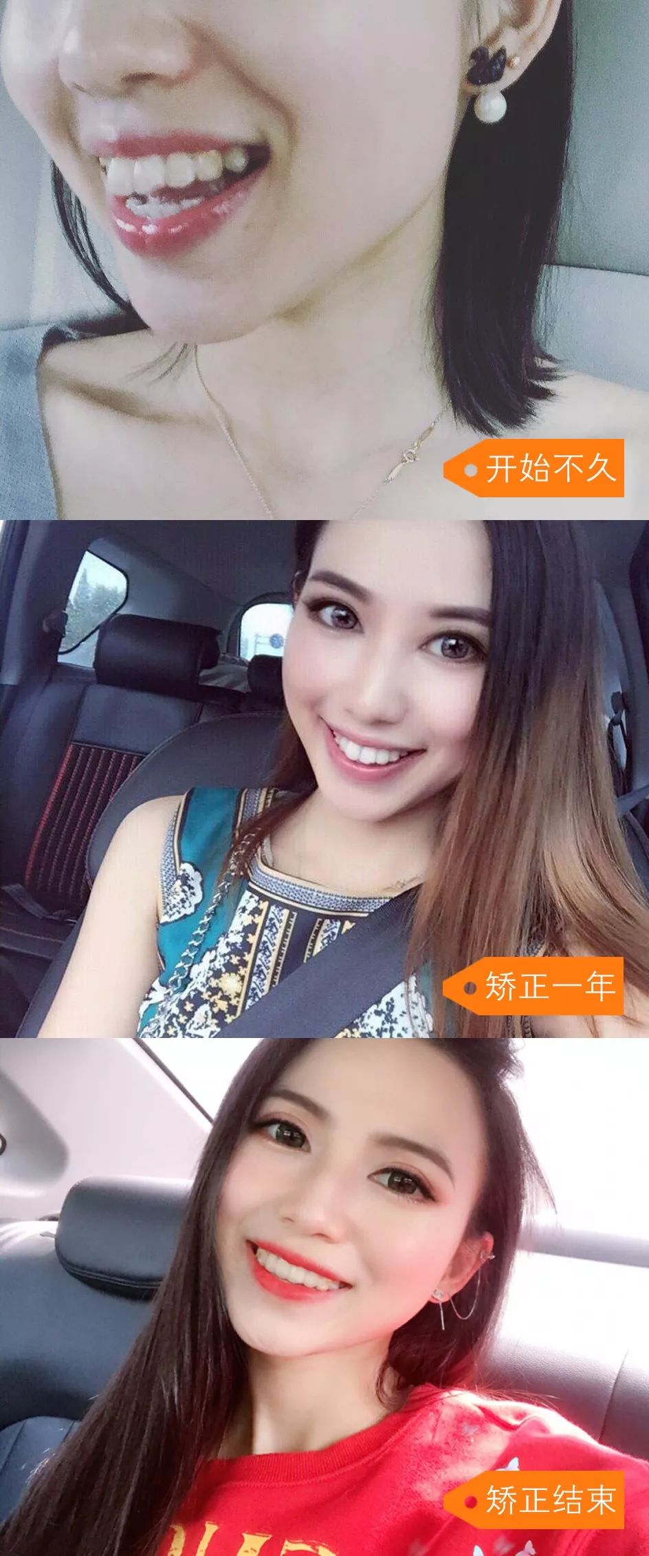 龅牙矫正前后对比照片,龅牙修复效果图