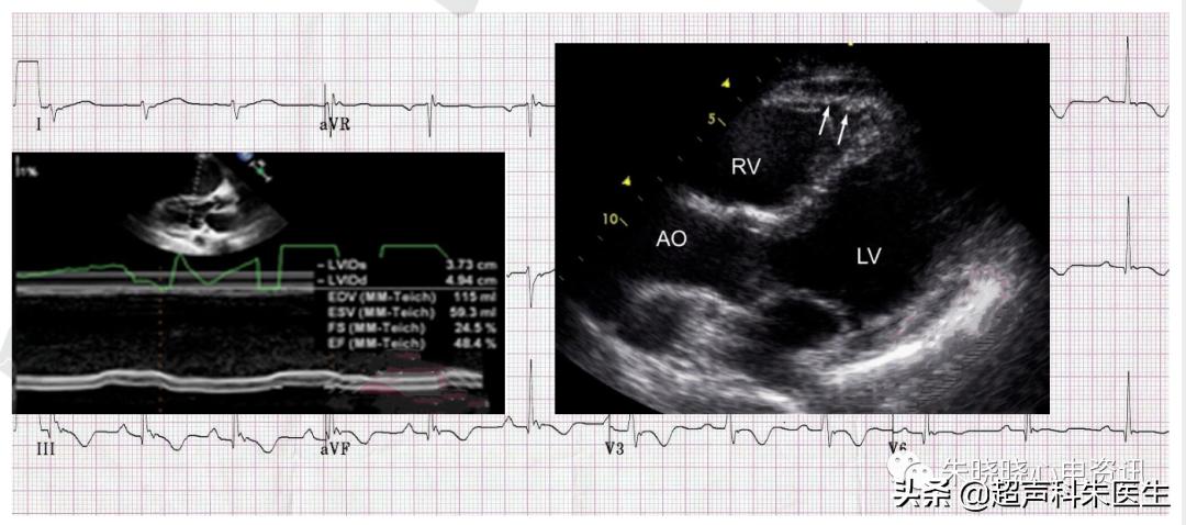 t波倒置9个真相图解,t波倒置判断口诀