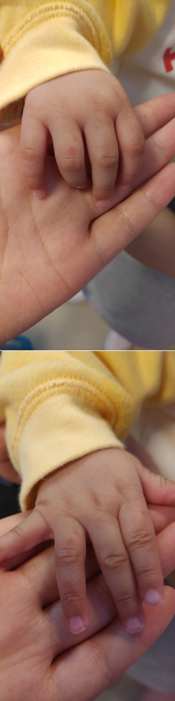 五个月宝宝手红肿了怎么回事,5个月宝宝手突然红肿是怎么回事