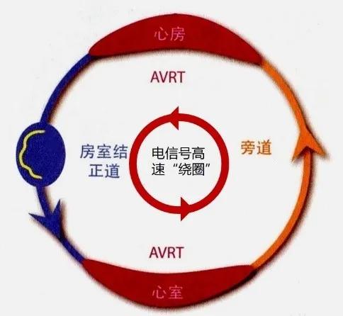 得了预激综合征严重吗,为什么会得预激综合征