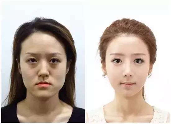 泰国最逆天的不是变性，而是堪比换头的整形