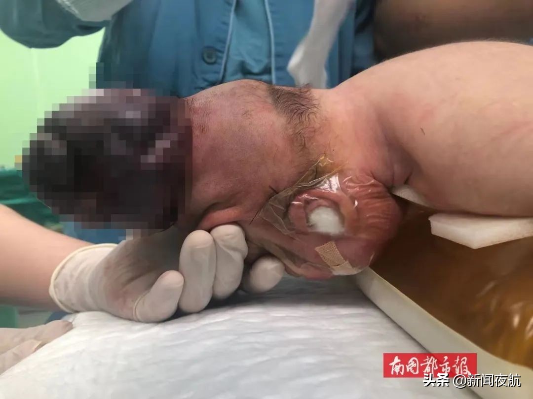 新生儿刚出生头顶侧面有个大包,宝宝一出生头上有个小包