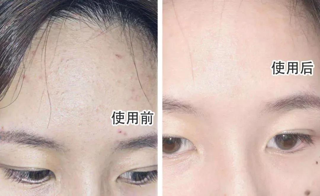 去角质慕斯可以去除死皮么,去角质慕斯去不去死皮