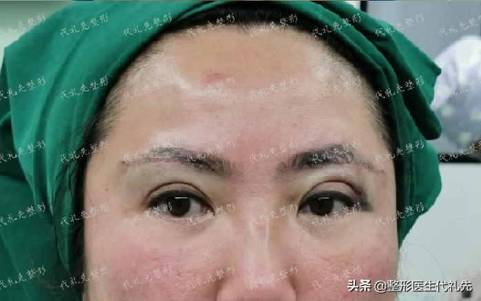 筋膜提眉术后遗症有多严重,提眉手术固定筋膜有后遗症吗