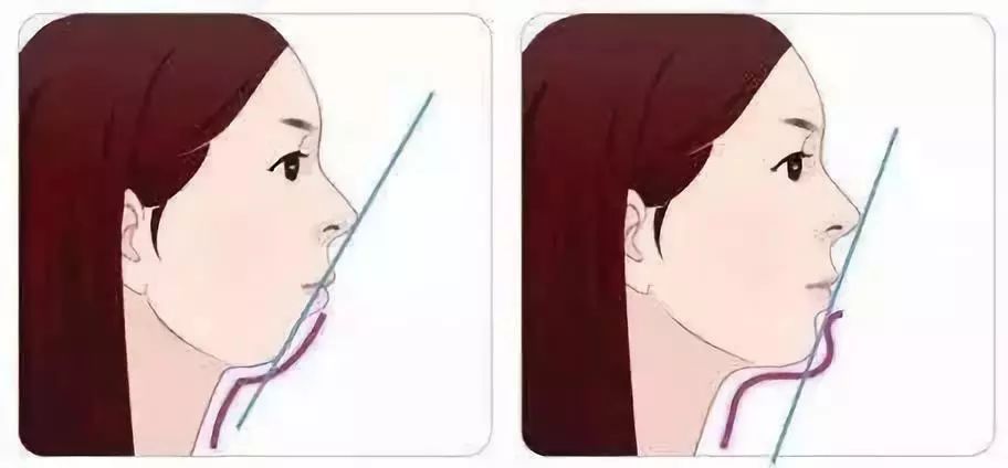 龅牙和深覆合有什么区别,龅牙矫正出现深覆合正常吗