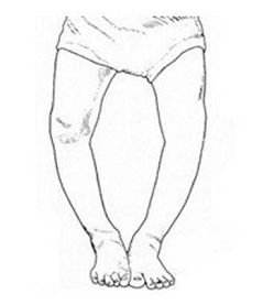 改善o型腿的日常小动作,o型腿简单粗暴的方法