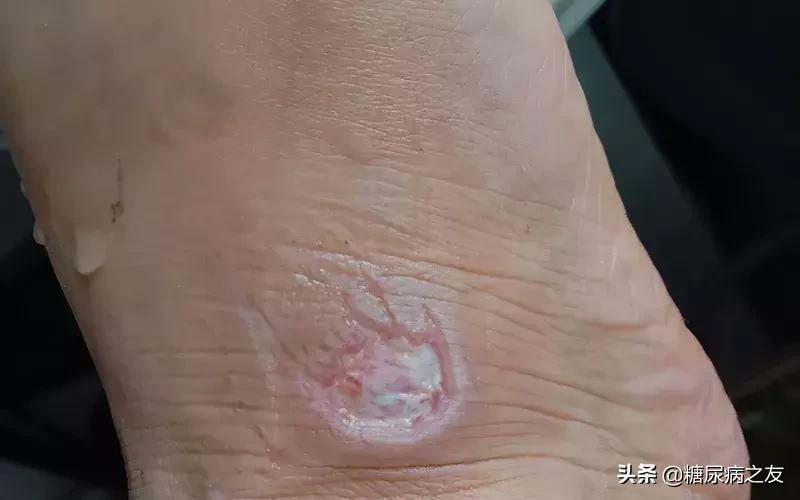 糖尿病足部神经病变有伤口能好吗,糖尿病足创面处理要点