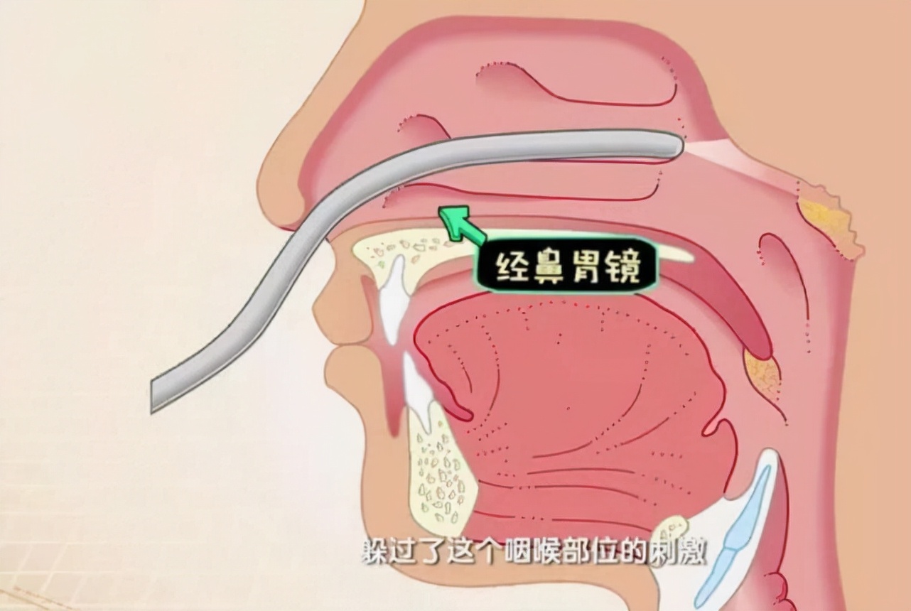 胃镜检查时医生把胃切了,胃镜检查医生说胃要切一般准吗
