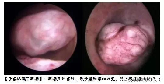 子宫肌瘤是咋把胎儿挤丢的？流产和不孕都是谁的错？备孕必读