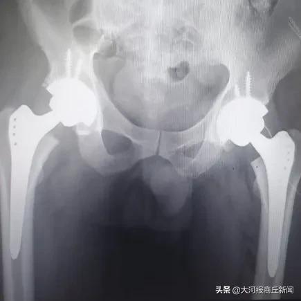 重塑健康!3小时4台关节置换圆满完成,柘城中医院再创新速度