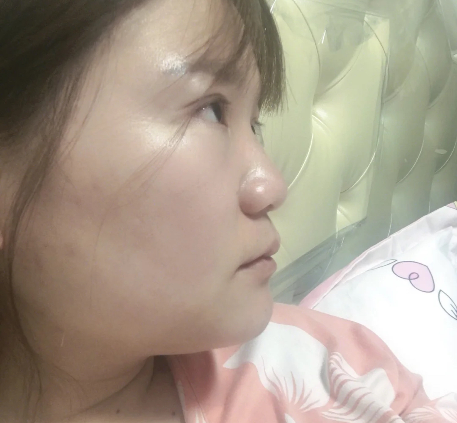 塌鼻梁蒜头鼻就一定丑吗,高鼻梁的蒜头鼻还能拯救吗