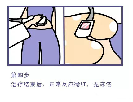 酷塑冷冻溶脂副作用是什么样的,酷塑冷冻溶脂的真实经历对比