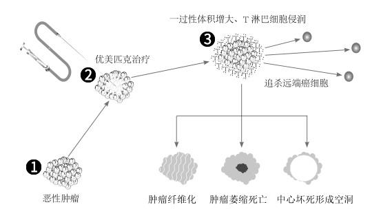 于保法看癌症的真实经历,肿瘤治疗专家于保法