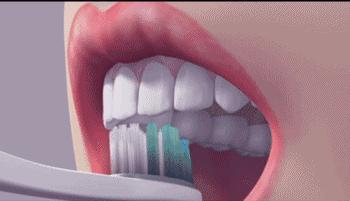 有了坏牙可以通过刷牙治疗吗,烂牙什么时候刷牙好