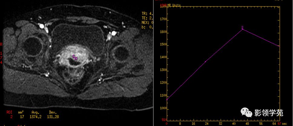 宫颈癌mri诊断,宫颈癌的mr扫描技术