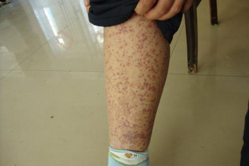 过敏性紫癜小红点会痒吗,不痛不痒的小红点是什么紫癜