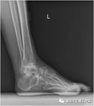 伊里扎洛夫外固定架治疗足部畸形,足部畸形矫正的技巧
