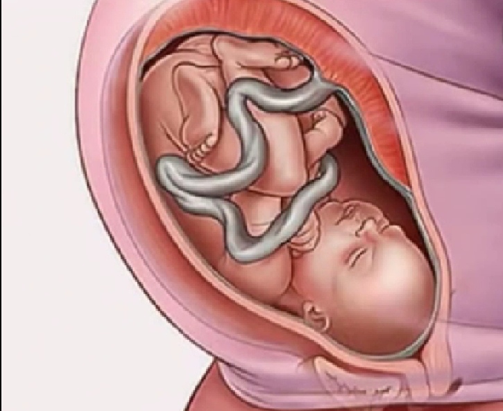 双胞胎胎儿几个月头朝下,怀孕9个月宝宝头朝下怎么样