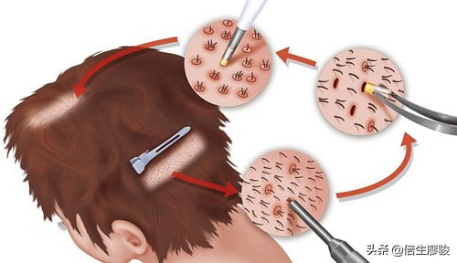 植发对额头的修饰,植发改善秃子