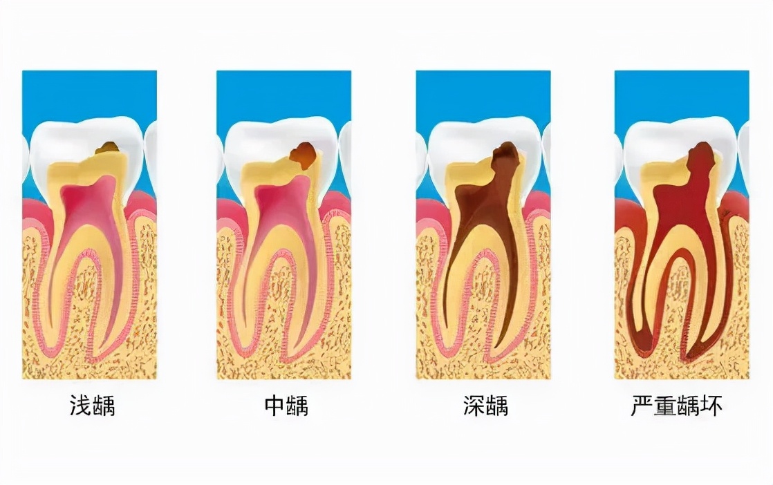 牙齿残根疼痛时可以拔掉吗,牙齿轻微疼痛可以去治疗吗