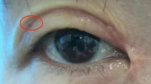 女子整容后惨不忍睹,女子双眼皮整容失败