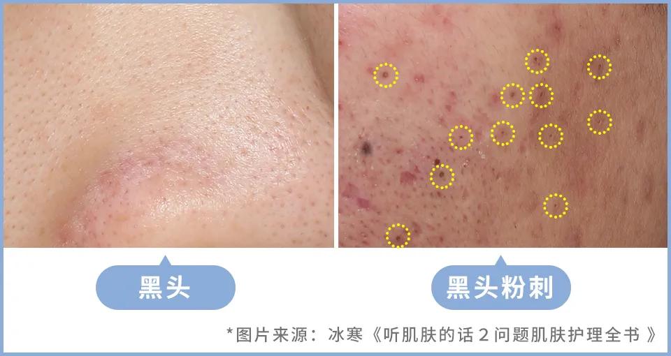 正确科学的去黑头方法一次说清楚,正确的去黑头的方法在这里