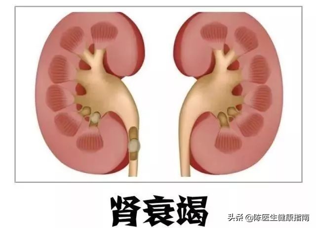 沙坦类降压药的副作用及禁忌,沙坦类降压药的禁忌
