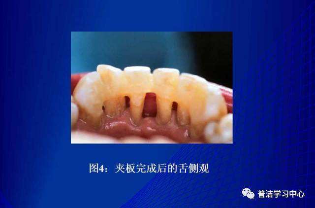 牙周疾病引起牙齿松动,牙周问题导致牙齿松动怎么办