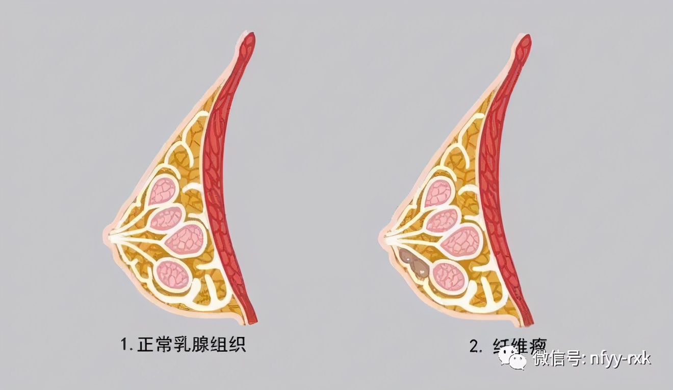 催奶师按摩会把乳腺结节按破吗,乳腺多发性结节可以按摩消除吗
